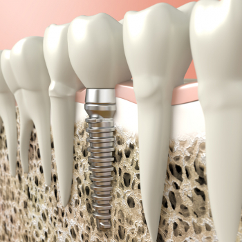 Implantate bei Zahnärztin Dr. Teutsch-Schlosser