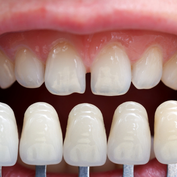 Veneers in der Zahnarztpraxis Dr. Teutsch-Schlosser